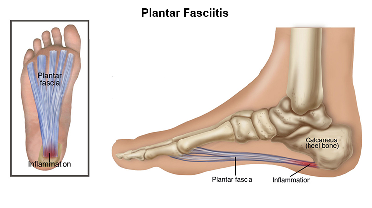 Plantar Fasciitis treatment in Dee Why - Contemporary Healthcare