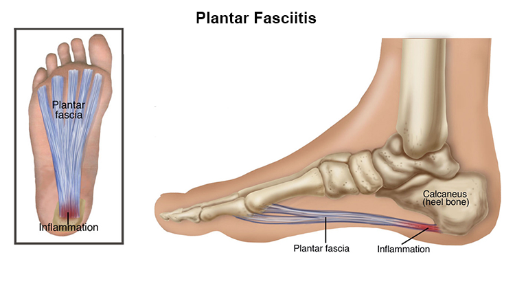 Plantar Fasciitis treatment in Dee Why