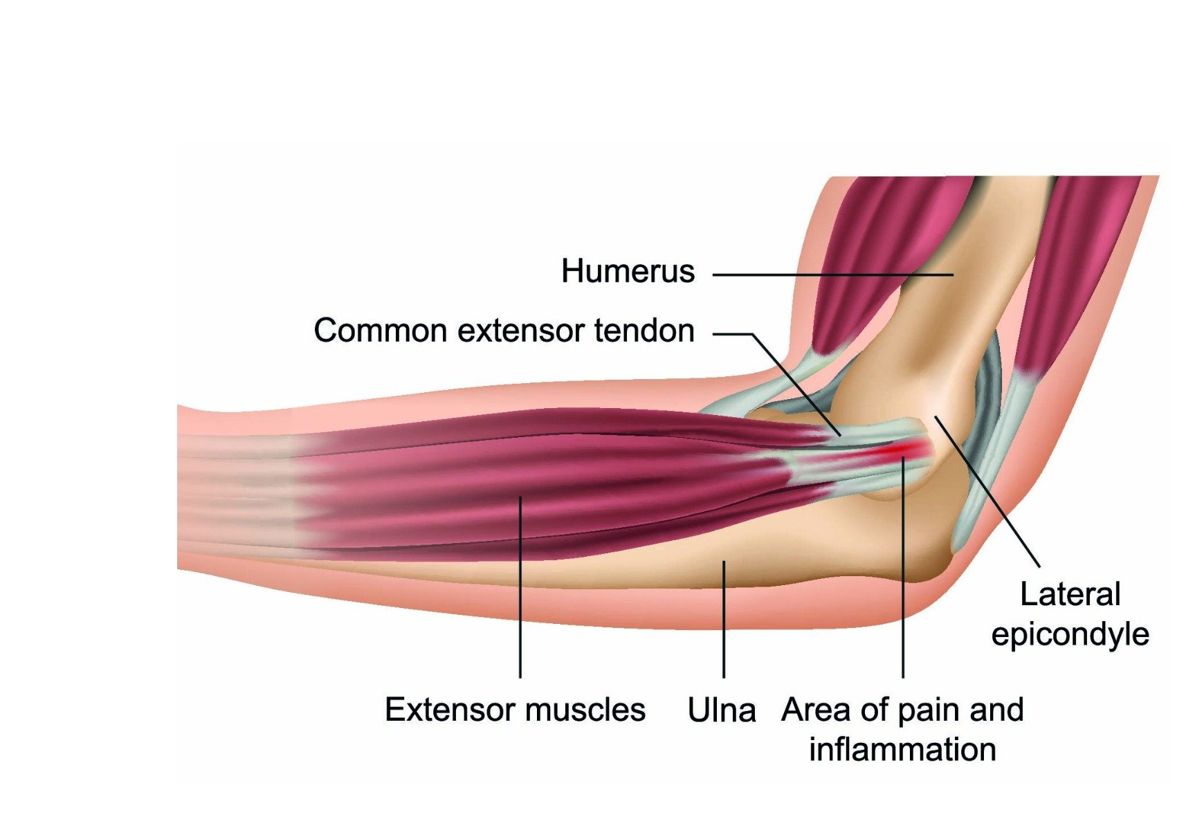Tennis Elbow treatment in Dee Why Contemporary Healthcare